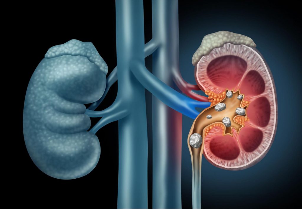 Stone Clinic - Kidney Stone Treatment